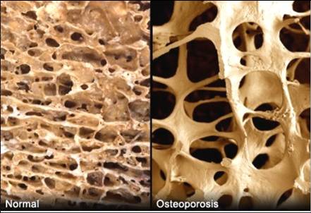 正常骨與骨質疏鬆骨的對比