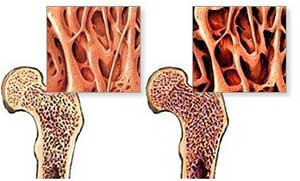 骨質疏鬆症