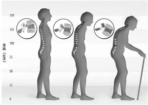 一個人骨骼變形的變化