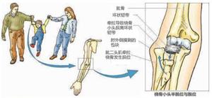 橈骨骨折保健