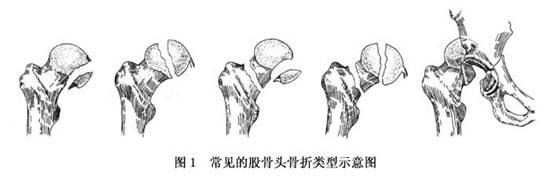 股骨頭麻豆激情床戏视频增加是什麽意思？平睡左腿收起左右擺動大點大腿根就痛。