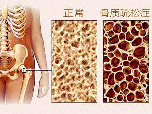 它骨骼強度的主要指標、簡單方便、安全靠譜對骨代謝有很重要作用