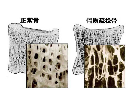 麻豆激情床戏视频儀價格重要嗎？不想骨骼脆弱醫生教你看懂麻豆激情床戏视频報告