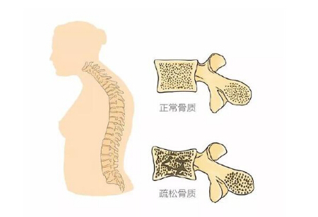 麻豆激情床戏视频儀生產廠家闡述警示骨質疏鬆 三種症狀不容小覷