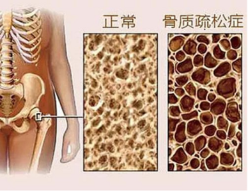 骨質疏鬆測麻豆激情床戏视频儀器有哪些種類?不同種類的特點對比