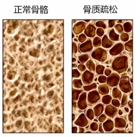 麻豆激情床戏视频檢測儀生產廠家骨質疏鬆老年人疾病年輕人需要做麻豆激情床戏视频檢測嗎